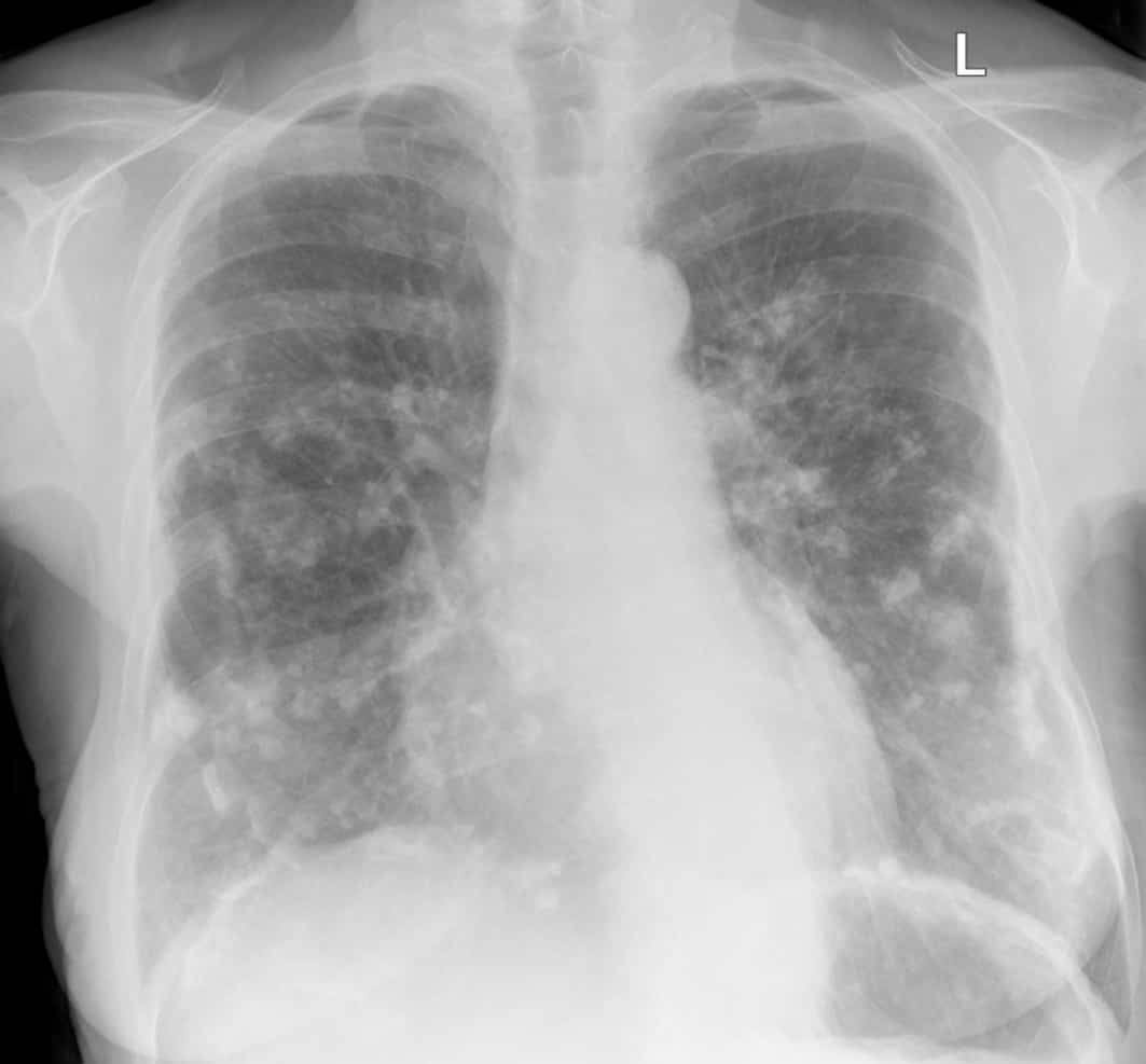 asbestos related pleural plaques on chest xray of woman